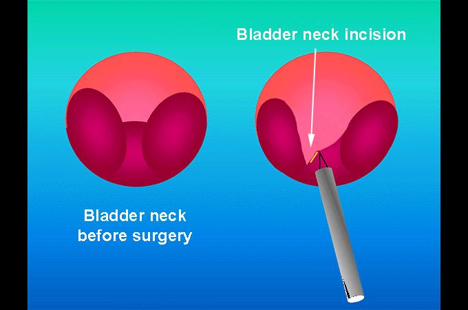 You will usually be given an injectable antibiotic before the procedure after checking for any drug allergies. The laser is used to incise through any tight areas in the bladder outlet and prostate.