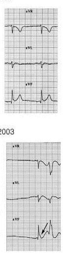 electrocardiogram: cellular basis and