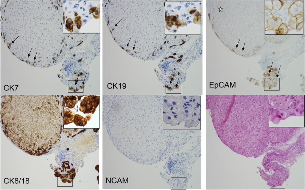 July 2010 KERATIN 7 AND HEPATOCARCINOGENESIS 339 Figure 3. Complementary analysis of the staining pattern of IHC.