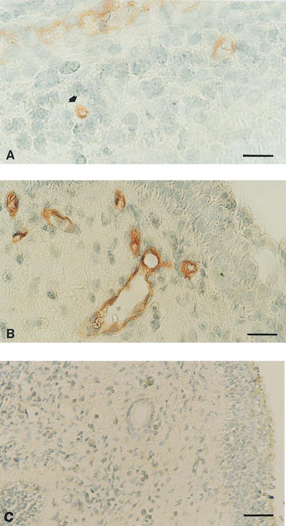 392 AMERICAN JOURNAL OF RESPIRATORY CELL AND MOLECULAR BIOLOGY VOL. 20 1999 Figure 2. Immunohistochemical localization of CD34 in nasal polyps.