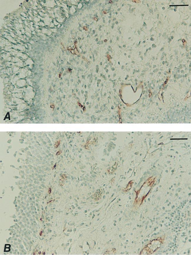 394 AMERICAN JOURNAL OF RESPIRATORY CELL AND MOLECULAR BIOLOGY VOL. 20 1999 Figure 4. CD34 staining in nasal polyps before and after treatment with systemic corticosteroids in one patient.