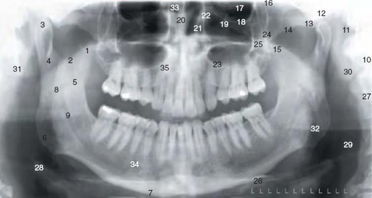 C) William S. Moore presents his landmarks of interest for the interpretation of the normal panoramic radiography: Figure 7: Interpreting a Normal Dental Panoramic Radiograph C 1. coronoid process 19.