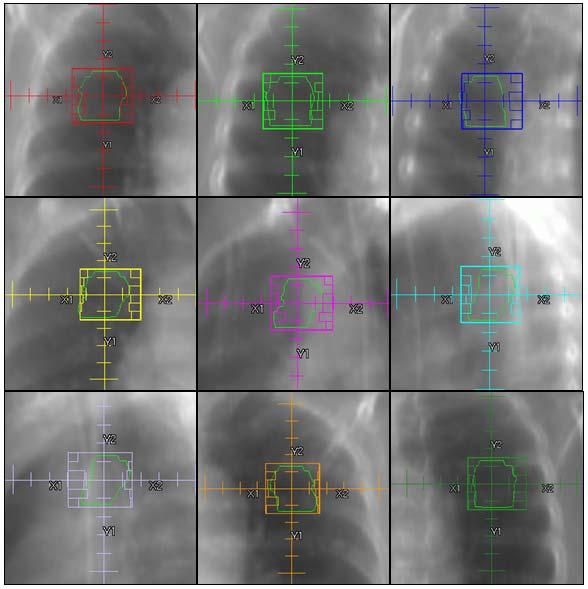 66 Fig. 22. Optimized MLC apertures for patient #11 Figure 23 shows the isodose regions for LUL targets for Case #11 computed on the respiratory phantom scan.