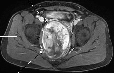 Figure 3: 52 year old male with a pelvic mass found to be an extrapleural