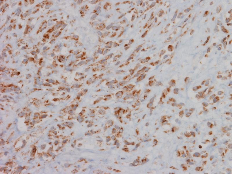 Figure 8: 52 year old male with a pelvic mass found to be an extrapleural solitary fibrous tumor. Tumor cells stain positive for Bcl-2 (200x magnification).