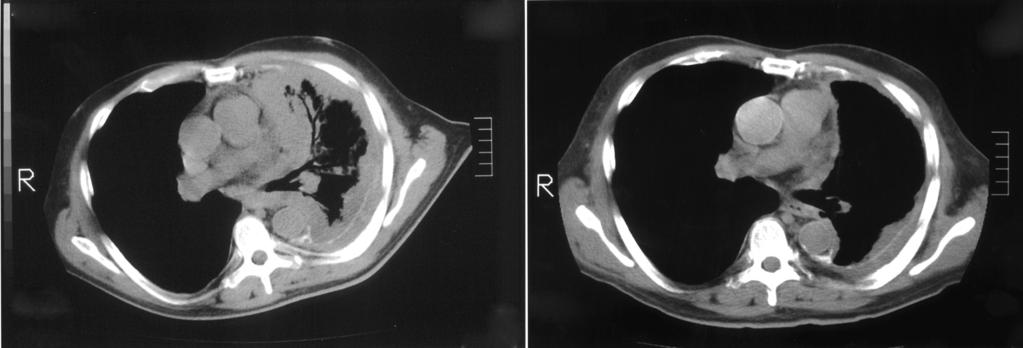 Annals of cardiothoracic surgery, Vol 1, No 4 November 2012 509 A B Figure 1 axial computed tomography scan showing pre-treatment disease (A) and a partial response to chemotherapy with cisplatin and