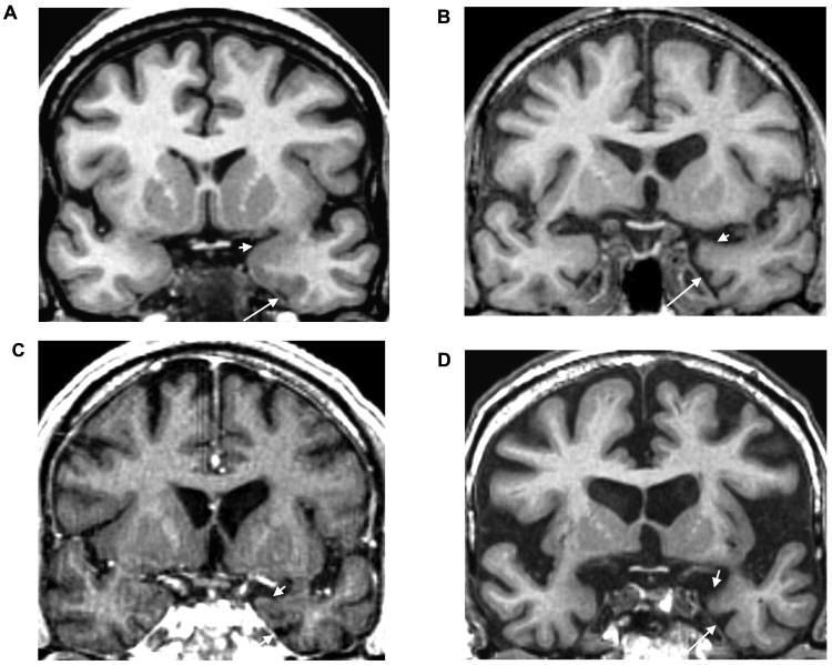 FIGURES Figure 1. MRI scans of healthy vs. advanced AD brains. (A) Healthy brain. (B, C, D) AD brains at different stages before diagnosis (41, 17, 11 months respectively) (Henry-Feugeas et al.