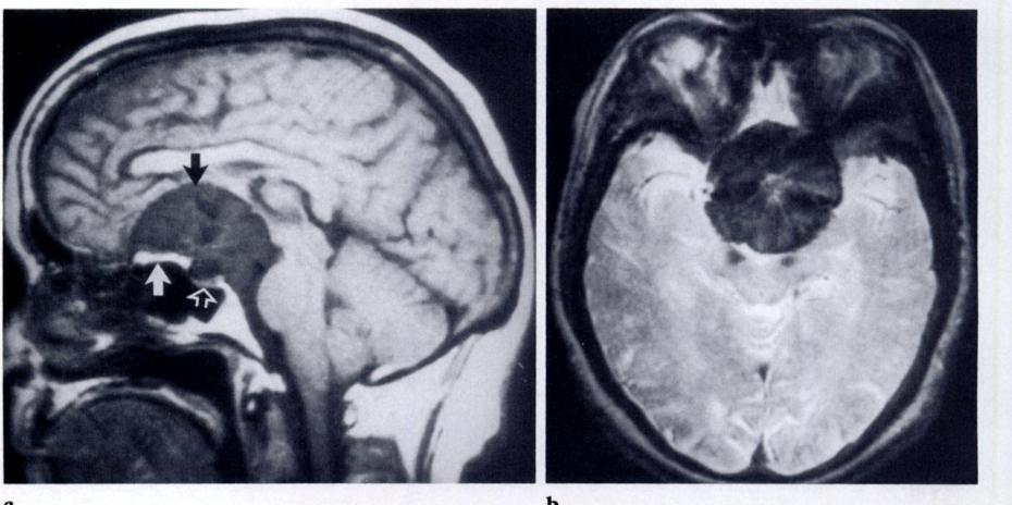 b I3I A2.11 J,., Figure 8. Suprasellar meningioma.