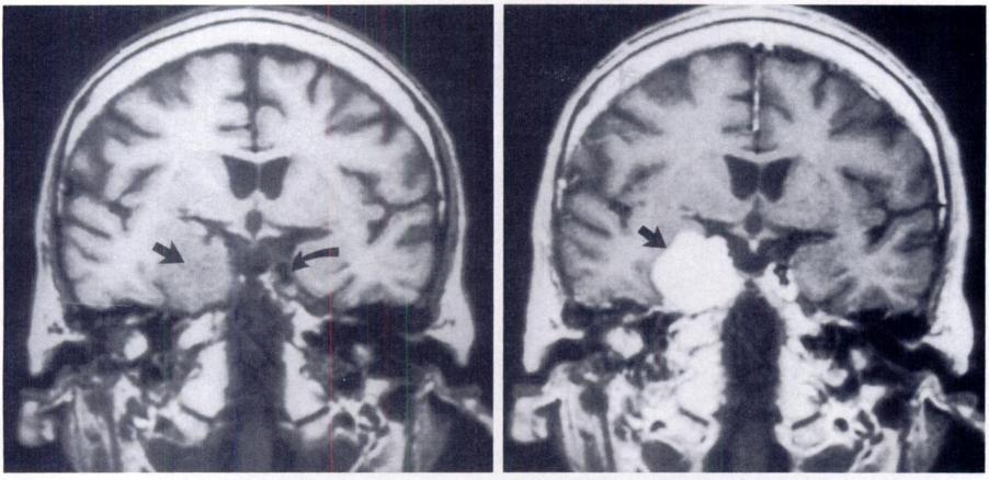 a. b. Figure 9. Parasellar meningioma. (a) Coronal Tiweighted MR image demonstrates an ill-defined mass isointense relative to gray matter (straight arrow) arising from the right cavernous sinus.