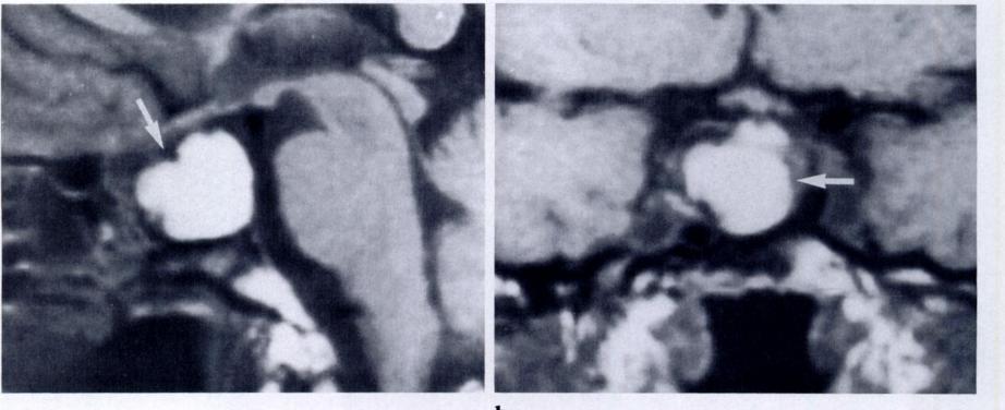 Figure 10. Craniopharyngioma. (a) Parasagittal Ti-weighted MR image demonstrates a homogeneous high-signal-intensity mass (arrow) filling the sella turcica and extending into the suprasellar cistern.