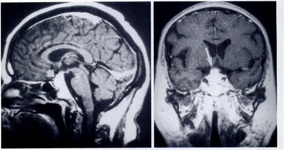 a. b. Figure i4 Granulomatous disease (sarcoidosis).