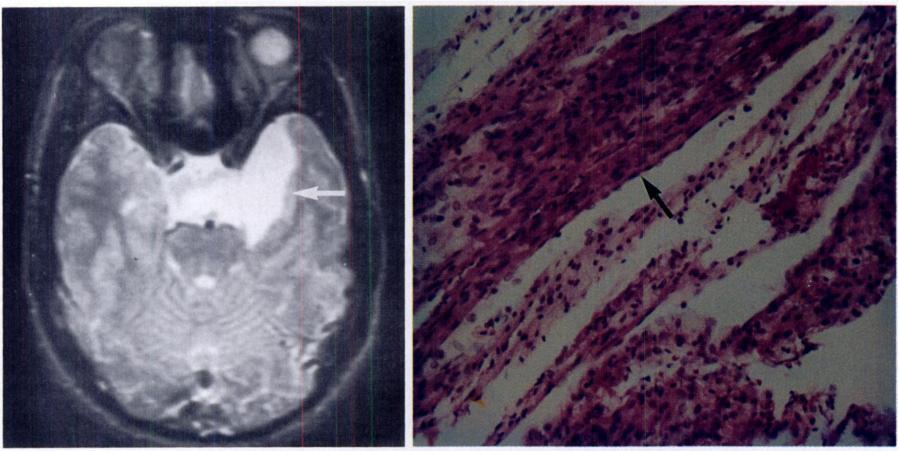 arrow). The mass is isointense relative to cerebrospinal fluid. (b) On coronal Tiweighted image, the mass extends into the left middle cranial fossa (straight arrow).
