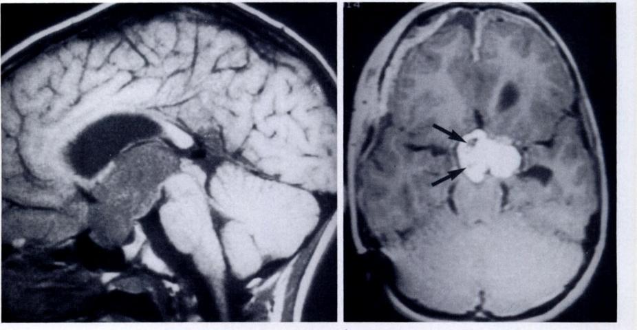 a. D. Figure 20. Hypothalamic glioma.