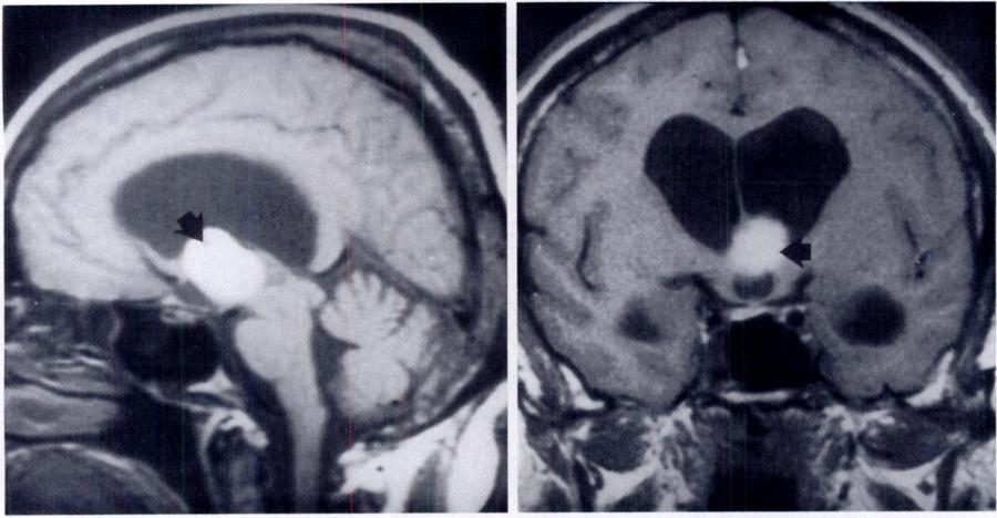 a. intermittent obstruction of one or both forab. Figure 27. Colloid cyst.