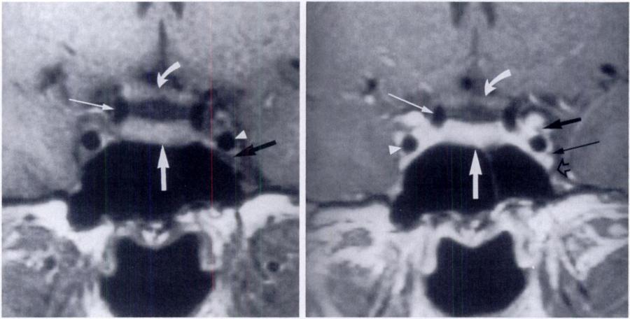 (b) Corresponding coronal Ti-weighted MR image shows the normal anatomic structures: adenohypophysis (thick white arrow), optic chiasm (curved arrow), supraclinoid internal carotid artery (thin white