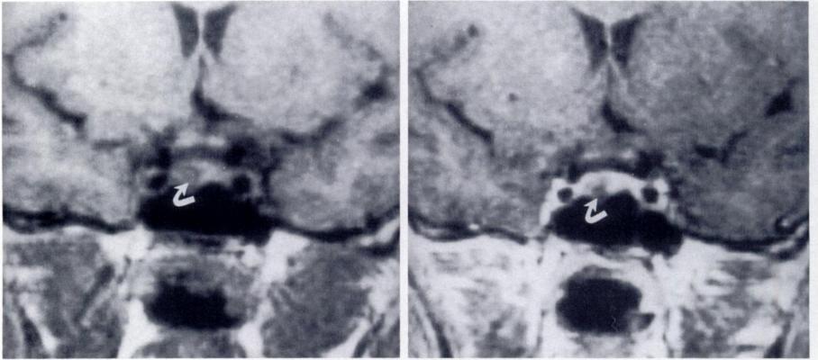 a. b. Figure 5. Microadenoma. (a) Coronal Ti-weighted MR image shows a 4-mm-diameter hypointense lesion (arrow) located within the pituitary gland, to the right of the midline.