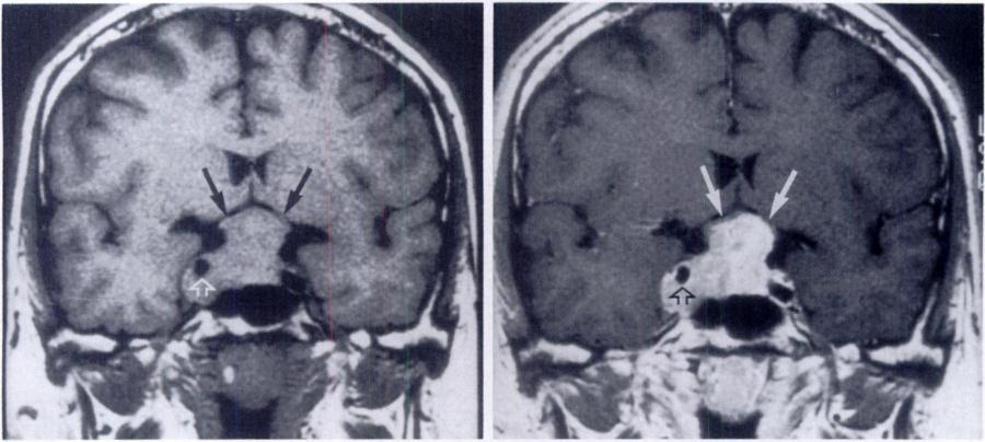 a. b. Figure 6. Macroadenoma. (a) Coronal Tiweighted MR image demonstrates a mass 23 mm in vertical dimension and isointense relative to white matter arising from the sella turcica.