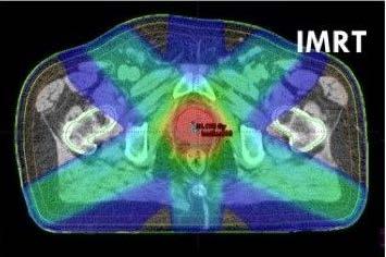 IMRT-Localized Prostate Cancer Daily radiation therapy for 8-9 weeks (40-48) Hypofractionated regimen (20-38) fractions Rectal and Bladder sparing