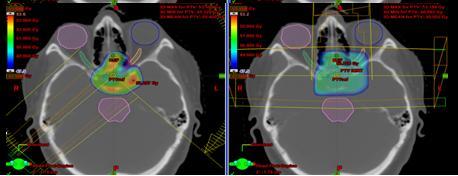 Knowledge about where post-radiotherapy failures occur in relation to the defined target is required to evaluate optimal target delineation.