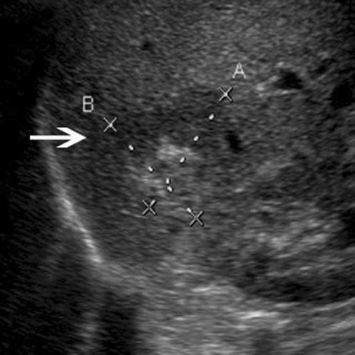 Hepatic angiomyolipomas: features on CEUS (a) (b) (c) (d) Figure 1. Hepatic angiomyolipoma in a 42-year-old woman.
