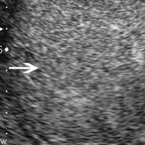 The lesion (arrow) shows isoenhancement in the (c) portal phase (100 s after contrast agent injection) and (d) late phase (130 s after contrast agent injection).