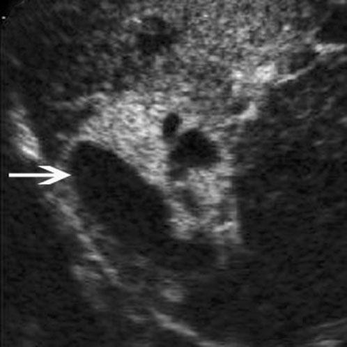 (b) In the arterial phase of contrast-enhanced ultrasound, the lesion (arrow) shows heterogeneous hyperenhancement 11 s after contrast agent injection.