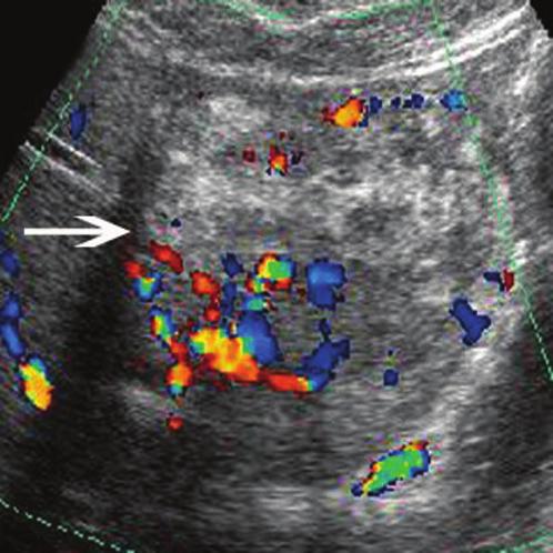 Hepatic angiomyolipomas: features on CEUS (a) (b) (c) (d) Figure 3. Hepatic angiomyolipoma (AML) in a 25-year-old woman. (a) Baseline ultrasound scan shows a mixed echogenic lesion (arrow) 8.