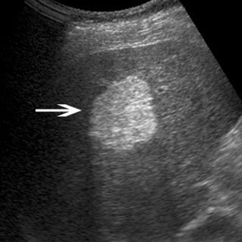 Hepatic angiomyolipomas: features on CEUS (a) (b) (c) (d) Figure 4. Hepatic angiomyolipoma in a 50-year-old woman. (a) Baseline ultrasound scan shows a homogeneously hyperechoic lesion (arrow) 2.