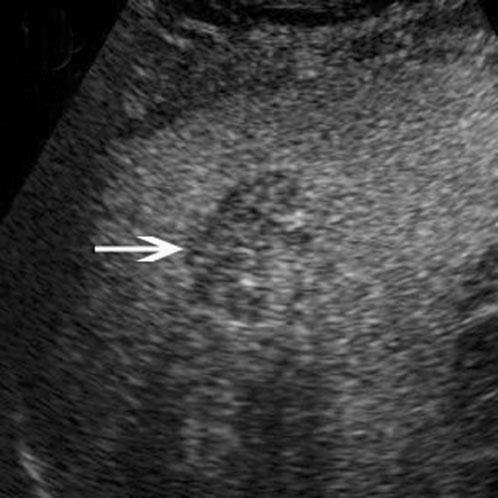 FNH also has similar characteristics to hepatic AML on CEUS; however, the isoechoic or hypoechoic feature on greyscale BUS and the spoke-wheel-shaped artery signals on colour Doppler imaging provide
