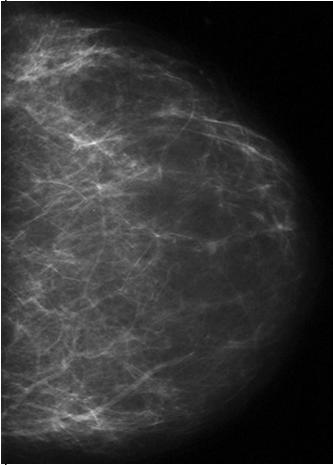 0 MHz produced images that could differentiate types of breast tissues 21 sites 2809 women (at least heterogeneously dense in one quadrant) Mammography and physician performed