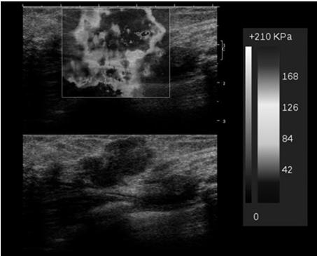 Non-invasive technique that adds value to the sonographic examination by evaluating the stiffness of tissue.