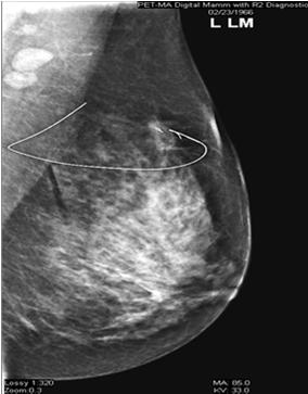 Lymph node Secondary lesion Index Lesion Great value in preoperative identification of non-invasive breast cancer (DCIS) DCIS accounts for 30% of
