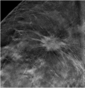 A suspicious area in a 2D Mammography Image The 2D Mammography