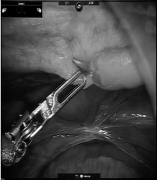 Robotic Pre-Peritoneal Ventral Hernia Repair video Advantages: Minimally Invasive Approach Robotic ventral hernia repair may bridge the gap between open and laparoscopic repairs Robotic ventral