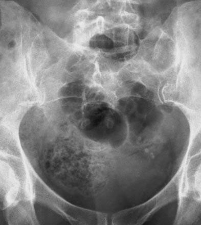 For smaller calculi, size is less of a determinant of detectability, with 63% being undetectable but 37% visible with radiography.