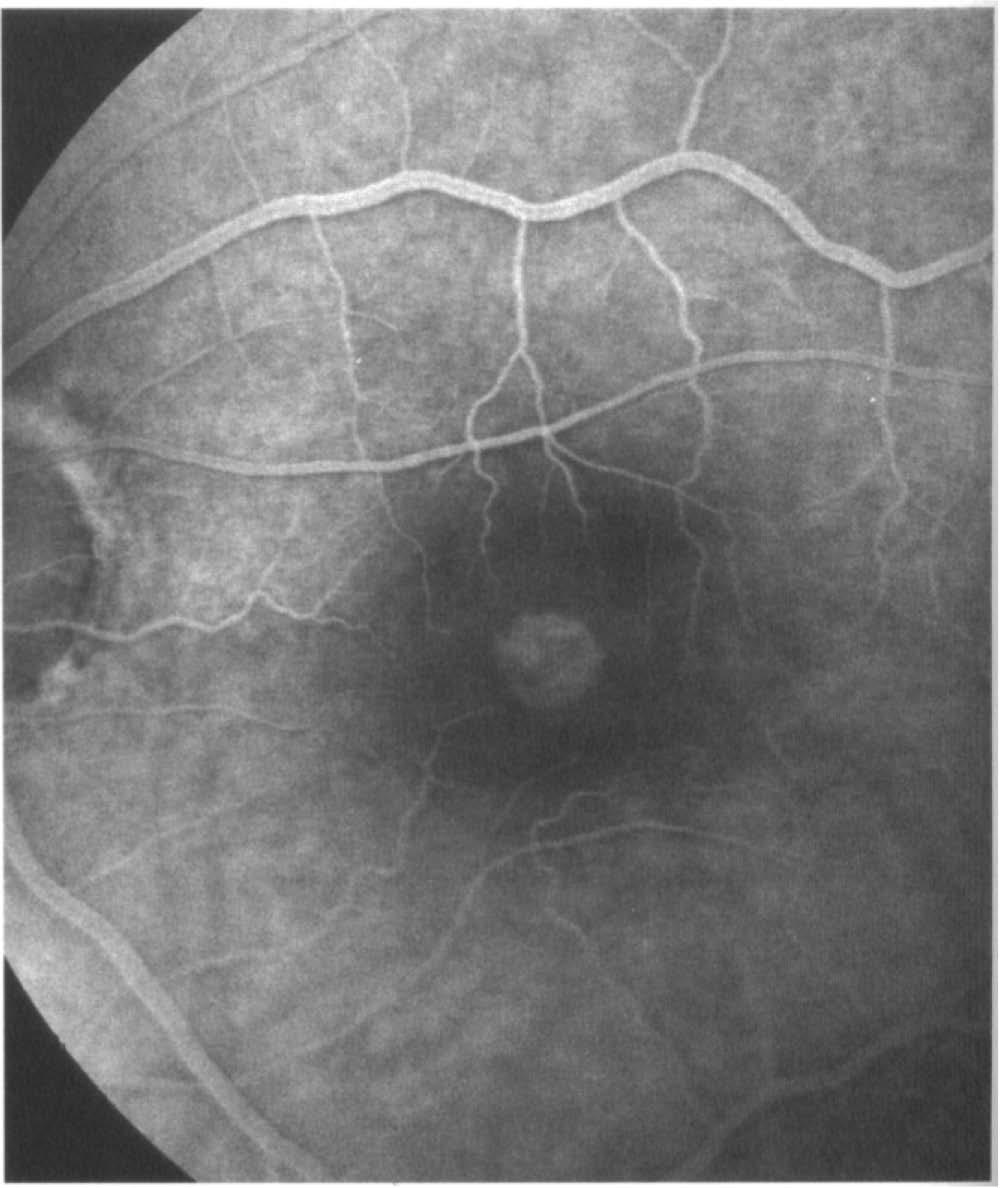594 ophthalmoscopy and slit lamp examination with a 78 or 90 dioptre lens and a Goldmann fundus contact lens if uncertainty regarding the stage of the FTMH existed.