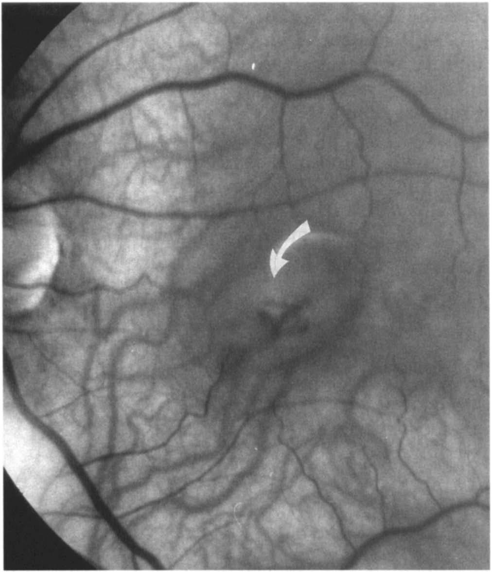 by Gass. 1, 2 The Watzke-Allen sign of an interruption in a thin beam of light directed across the macular hole was used to assist in the diagnosis.