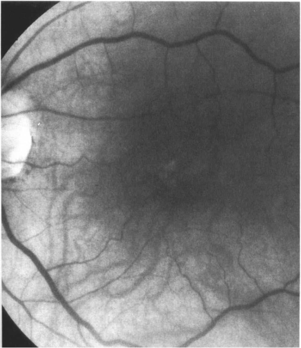 SERUM IN SURGICAL TREATMENT OF MACULAR HOLES 595 (a) Fig. 2. (a) A red-free photograph of the same case as Fig. 1 taken 3 months post-operatively, demonstrating closure of the macular hole.