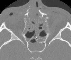 Complex strut fractures Central midface Nasofrontoethmoidal Nasomaxillary