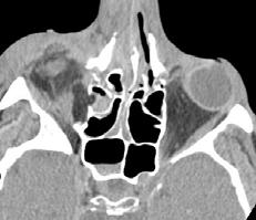 Nasoorbitoethmoidal fractures Medial Maxillary Buttress Fracture Nasal bones,