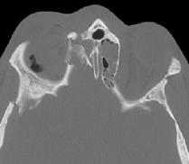 strut fractures Maxilloalveolar buttress Central midface Nasofrontoethmoidal