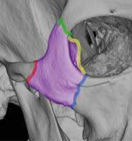 Complex strut: Lateral Midface Zygomaticomaxillary complex fracture Complex strut: