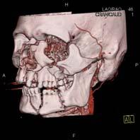 Obstruction and mucocele Isolated maxillary wall Complication: dacrocystitis Isolated