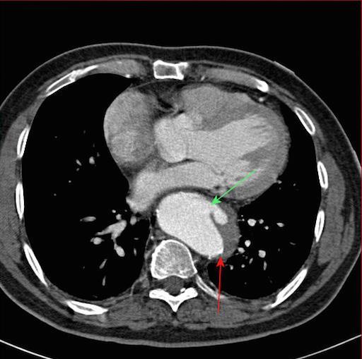 PAU with Intramural Hematoma Patient presents with acute chest pain PAU with focal protrusion of