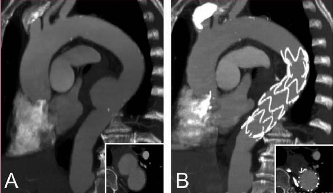 Thoracic Stent-Grafting for PAU Before After From Kische S et al.