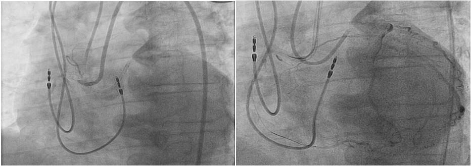 Case Series At the University of Washington, we have begun using the Flash Ostial System on a routine basis for PCI involving the ostium of the RCA.