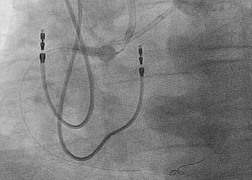 Figure 3: Solving the Dilemma of Ostial Stenting in 69 years old man Case 2: 71 year-old male with CCS class III angina despite optimal medical therapy (beta-blocker and long-acting nitrates) who