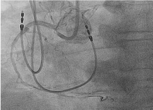 He subsequently underwent angiography that showed significant three vessel obstructive coronary artery disease (80% mid-lad, CTOs of the RCA and left circumflex [LCX] coronary arteries).
