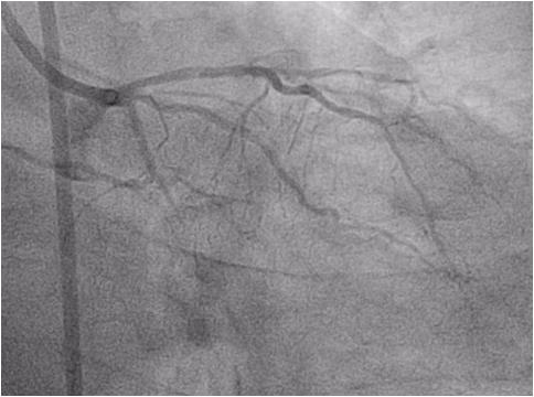 The patient was not a candidate for coronary artery bypass surgery and was referred for PCI of his RCA and LCX CTOs.
