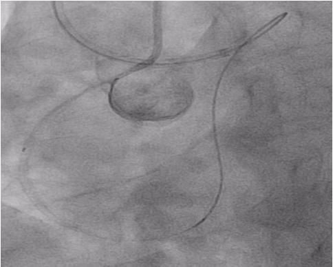 year-old female with a history of coronary